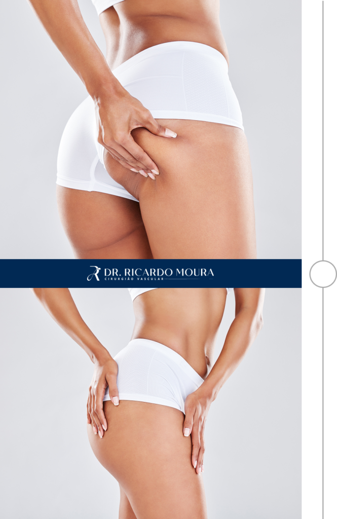 Harmonização glútea e das pernas guiada por ultrassom - Dr. Ricardo Moura Formiga MG