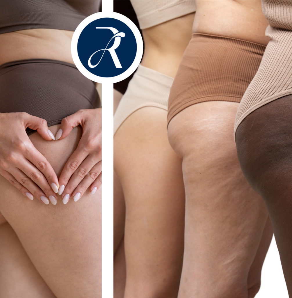 Tratamento de lipedema em Formiga MG - Dr. Ricardo Moura cirurgião vascular